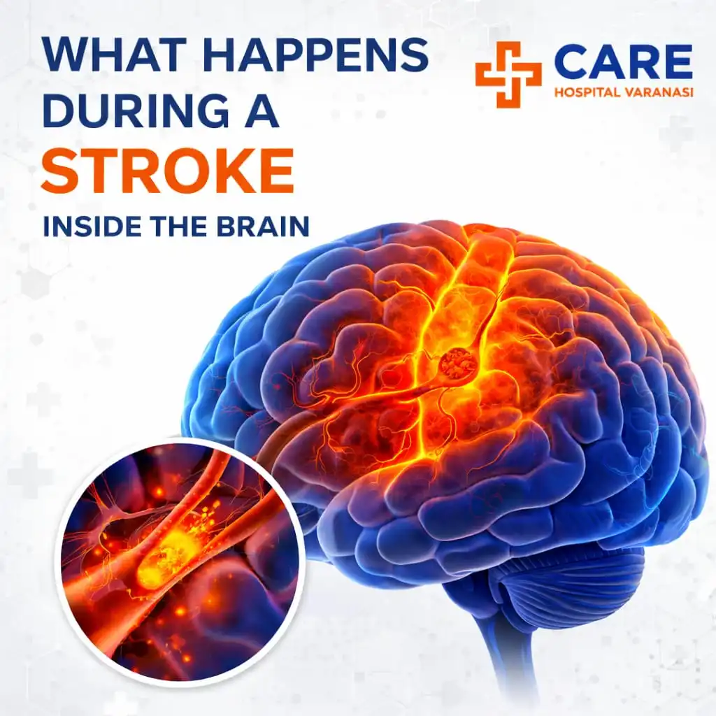 Illustration showing what happens during a stroke inside the brain, highlighting blocked blood flow and brain damage, presented by Care Hospital Varanasi.